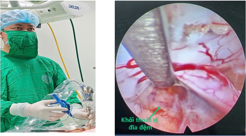 BỆNH VIỆN ĐA KHOA BẮC NINH SỐ 2: PHẪU THUẬT NỘI SOI  LẤY ĐĨA ĐỆM THOÁT VỊ, GIẢI ÉP ỐNG SỐNG THÀNH CÔNG  CHO BỆNH NHÂN 65 TUỔI