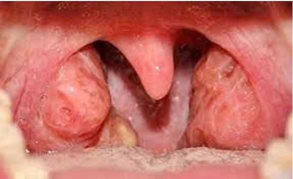 CẮT AMIDAN – KHI NÀO CẦN THIẾT VÀ GIẢI PHÁP ĐIỀU TRỊ AN TOÀN