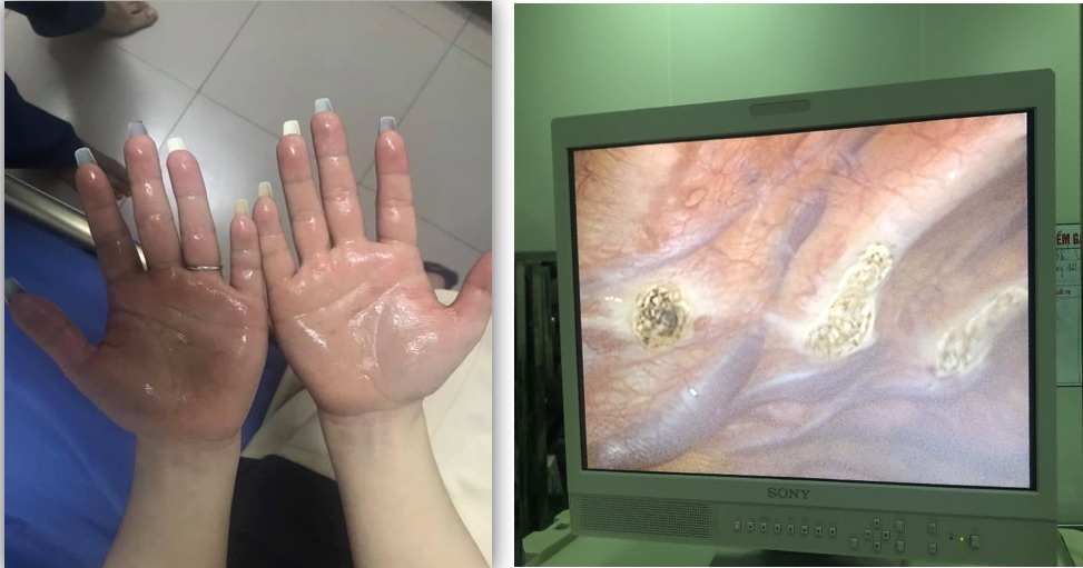 PHẪU THUẬT NỘI SOI ĐIỀU TRỊ TĂNG TIẾT MỒ HÔI TAY TẠI BỆNH VIỆN ĐA KHOA TỈNH BẮC NINH