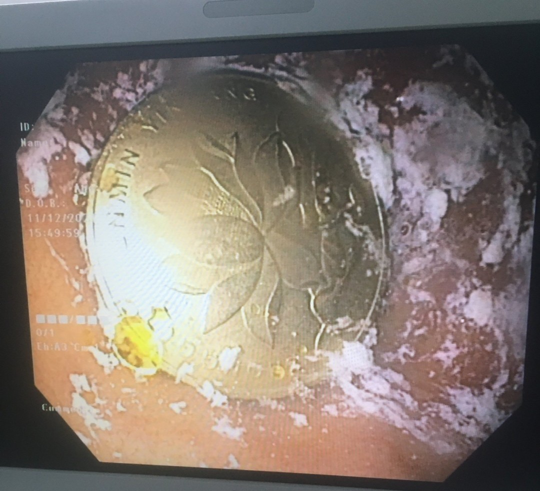 NỘI SOI GÂY MÊ GẮP DỊ VẬT DẠ DÀY THÀNH CÔNG CHO BỆNH NHI 26 THÁNG TUỔI NỘI SOI GÂY MÊ GẮP DỊ VẬT DẠ DÀY THÀNH CÔNG CHO BỆNH NHI 26 THÁNG TUỔI