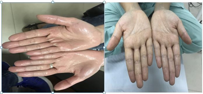 Phẫu thuật nội soi điều trị tăng tiết mồ hôi tay do cường hệ thần kinh giao cảm