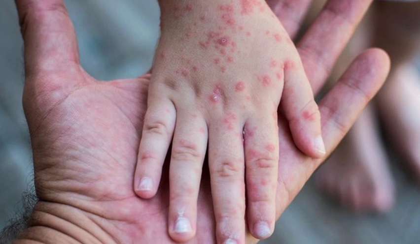 BỘ Y TẾ: ĐỘ TUỔI MẮC SỞI ĐÃ CÓ THAY ĐỔI SAU THỜI ĐIỂM KẾT THÚC CHIẾN DỊCH TIÊM VACCINE