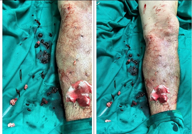 ĐIỀU TRỊ HIỆU QUẢ SUY TĨNH MẠCH CHI DƯỚI BẰNG LASER – CÔNG NGHỆ TIÊN TIẾN GIÚP NGƯỜI BỆNH “NHẸ BƯỚC” TRỞ LẠI CUỘC SỐNG