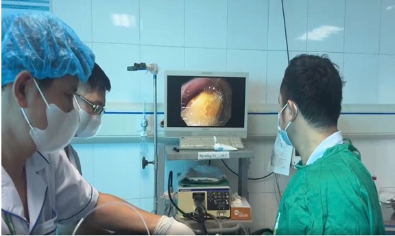 NỘI SOI GẮP THÀNH CÔNG HẠT MÍT MẮC TRONG THỰC QUẢN CHO NGƯỜI BỆNH 43 TUỔI