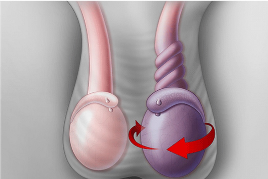 XOẮN TINH HOÀN - CẤP CỨU NAM KHOA KHÔNG ĐƯỢC CHẬM TRỄ