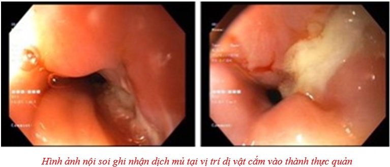 NỘI SOI LẤY MẢNH XƯƠNG GÀ  CẮM SÂU TRONG THỰC QUẢN NGƯỜI BỆNH 70 TUỔI