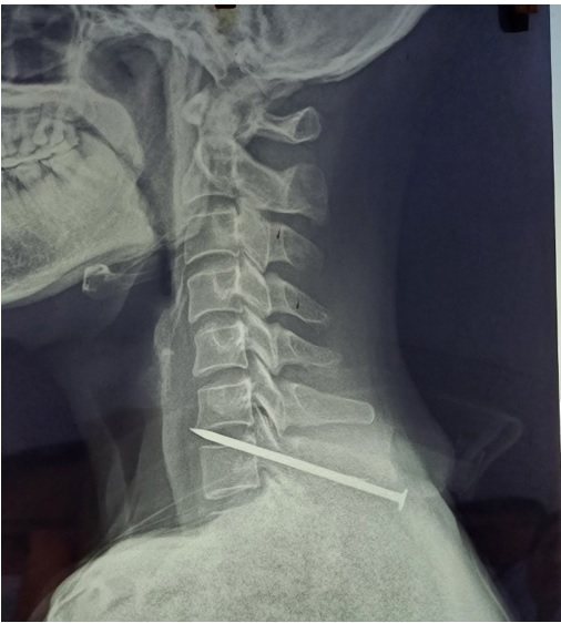   CẤP CỨU THÀNH CÔNG CA BỆNH  VẾT THƯƠNG NGHIÊM TRỌNG VÙNG CỔ DO SÚNG BẮN ĐINH