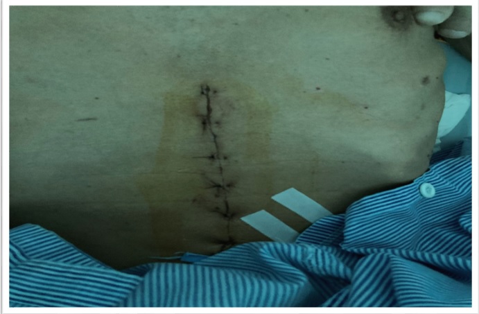 CAN THIỆP DINH DƯỠNG GIÚP NGƯỜI BỆNH CÓ ĐỦ ĐIỀU KIỆN PHẪU THUẬT ĐIỀU TRỊ UNG THƯ DẠ DÀY