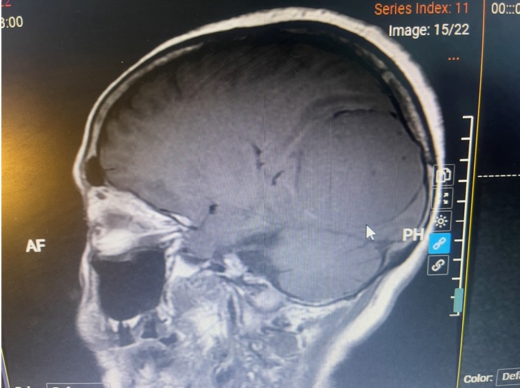 PHẪU THUẬT CẤP CỨU THÀNH CÔNG 02 TRƯỜNG HỢP CHẤN THƯƠNG SỌ NÃO TRẺ EM NẶNG  VÀ U NÃO LỚN