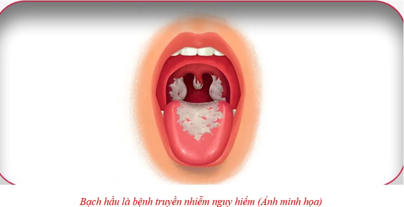 BẠCH HẦU CÓ LÂY TRUYỀN QUA ĐƯỜNG TÌNH DỤC?