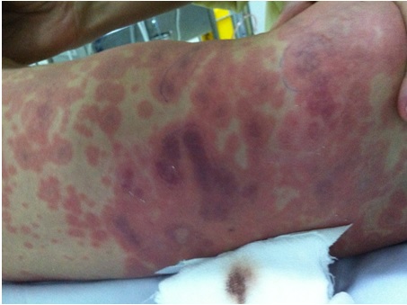 ​ BỆNH VIÊM MÀNG NÃO MÔ CẦU LÀ BỆNH GÌ? NGUYÊN NHÂN, TRIỆU CHỨNG, CÁCH PHÒNG TRÁNH