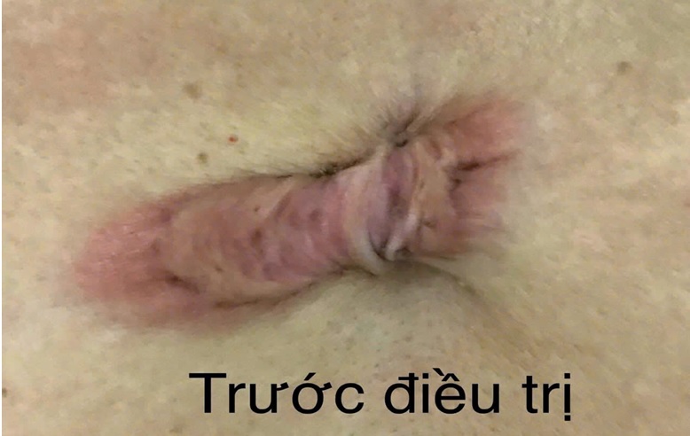 ĐIỀU TRỊ HIỆU QUẢ SẸO LỒI TẠI KHOA DA LIỄU ĐIỀU TRỊ HIỆU QUẢ SẸO LỒI TẠI KHOA DA LIỄU