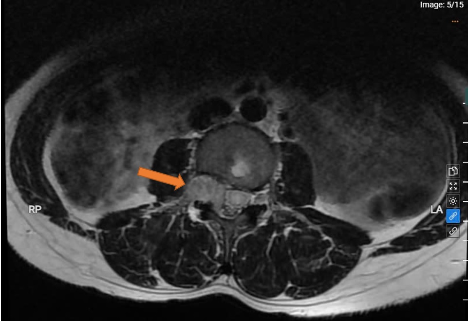 PHẪU THUẬT THÀNH CÔNG KHỐI U TỦY SỐNG CHÈN ÉP TỦY – GIÀNH LẠI CUỘC SỐNG CHO BỆNH NHÂN NỮ TRẺ TUỔI