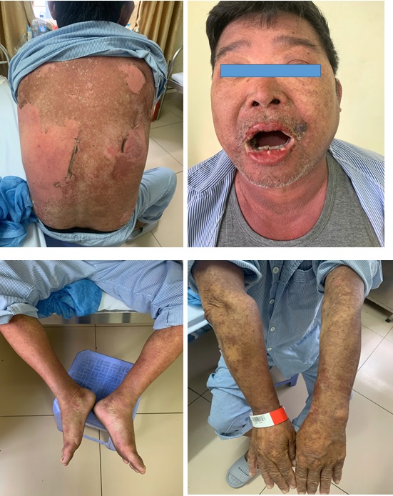 ĐIỀU TRỊ THÀNH CÔNG 02 CA DỊ ỨNG THUỐC NẶNG ĐIỀU TRỊ THÀNH CÔNG 02 CA DỊ ỨNG THUỐC NẶNG