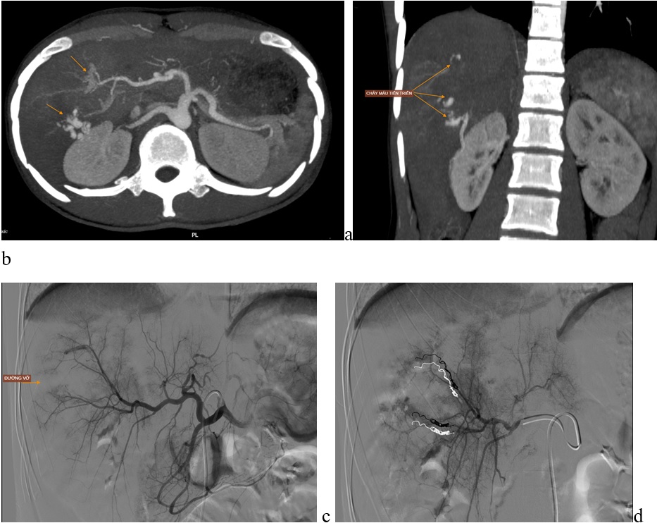 LIÊN TIẾP CÁC BỆNH NHÂN CHẤN THƯƠNG VỠ TẠNG ĐƯỢC ĐIỀU TRỊ ỔN ĐỊNH BẰNG PHƯƠNG PHÁP CAN THIỆP MẠCH LIÊN TIẾP CÁC BỆNH NHÂN CHẤN THƯƠNG VỠ TẠNG ĐƯỢC ĐIỀU TRỊ ỔN ĐỊNH BẰNG PHƯƠNG PHÁP CAN THIỆP MẠCH