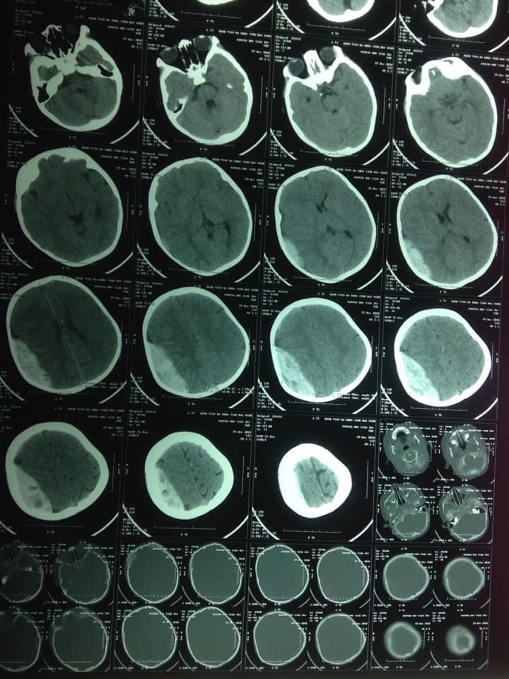 Hình ảnh phim cắt lớp vi tính sọ trước phẫu thuật