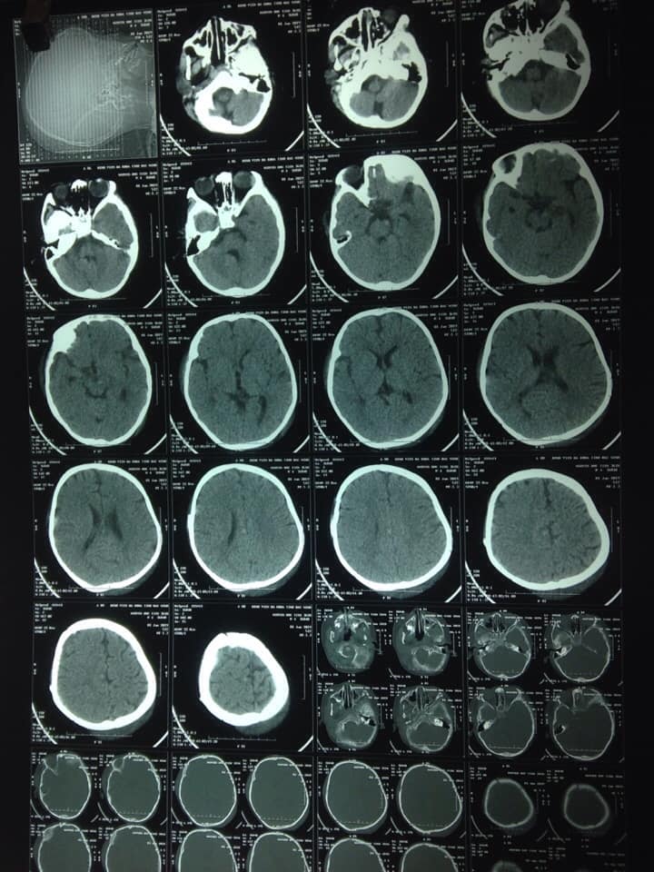 Hình ảnh phim cắt lớp vi tính sọ sau phẫu thuật