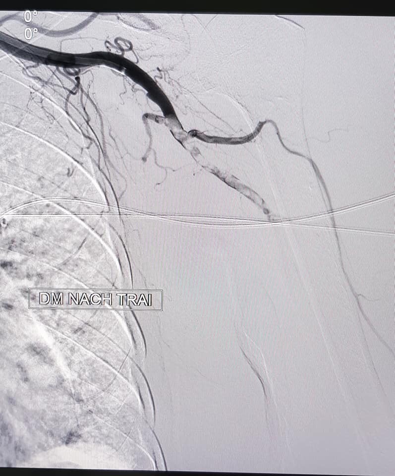 Hình ảnh chụp động mạch tay trái của bệnh nhân bị cục máu đông làm tắc hoàn toàn động mạch nách, liên tục đến động mạch cánh tay và động mạch vùng cẳng tay